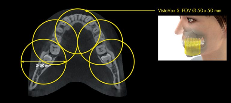 Vorlage_FoV_VistaVoxS_180912_DE.indd
